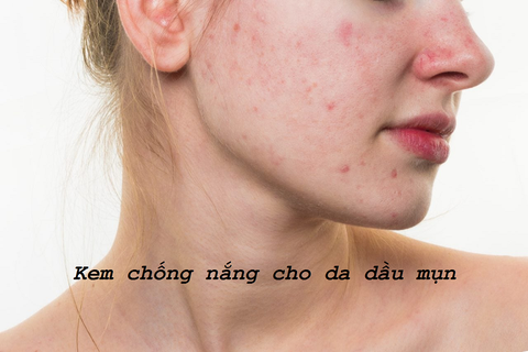Da dầu mụn nên dùng kem chống nắng gì?