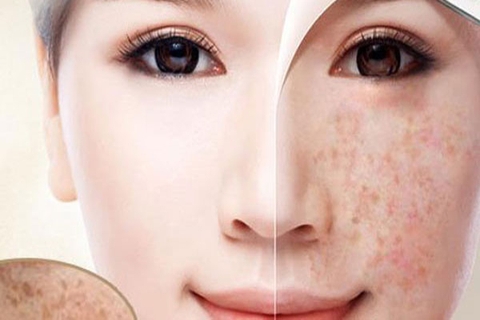 Tổng hợp các loại kem trị nám hiệu quả hiện nay