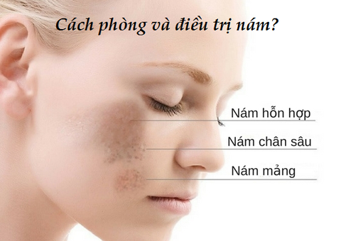 CÁCH TRỊ NÁM DA MẶT LÂU NĂM - CÁCH TỐT NHẤT ĐỂ PHÒNG VÀ ĐIỀU TRỊ NÁM DA HIỆN NAY