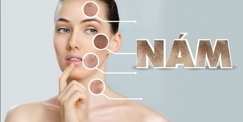 NÁM DA, NHỮNG NGUYÊN NHÂN - CÁCH TRỊ NÁM DA MẶT LÂU NĂM