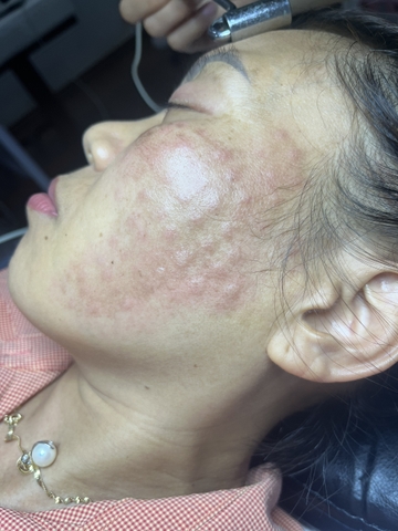 Trị nám da bằng mesotherapy có hiệu quả không?