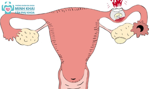 Mang Thai Ngoài Tử Cung Có Giữ Được Không? Nguy Hiểm Ra Sao?