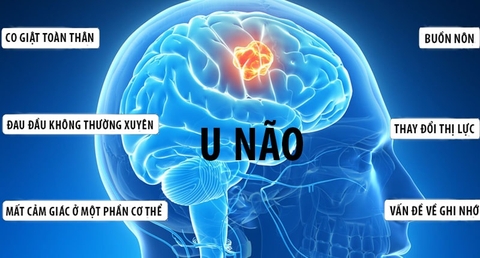 5 dấu hiệu chứng tỏ bạn đã mắc bệnh về não