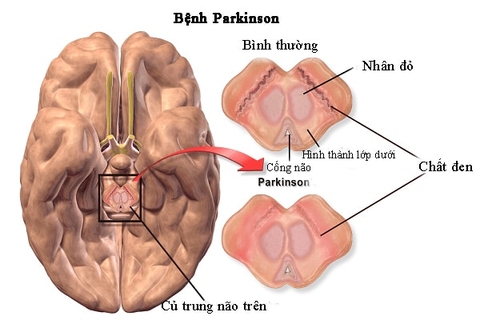 Hội chứng liệt rung parkinson vị thành niên