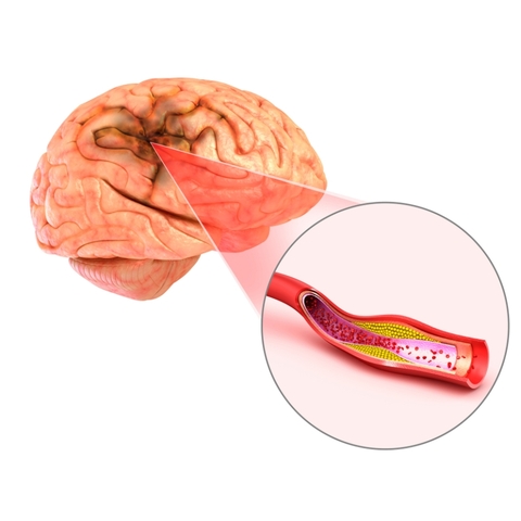 10 bí quyết tránh đột quỵ