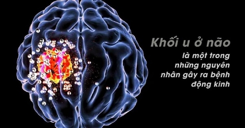 Bệnh não do phản ứng tự miễn
