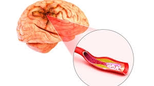 Hay bị đau đầu là bệnh gì?