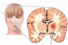 Các di chứng thường gặp của nhồi máu não