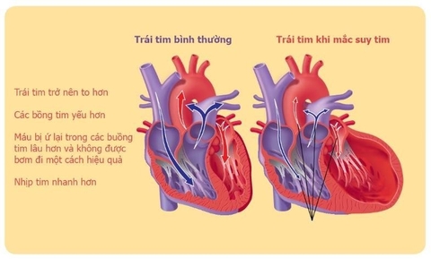 7 bệnh tim mạch thường gặp và các triệu chứng điển hình