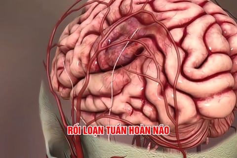 Chẩn đoán rối loạn ở tiểu não