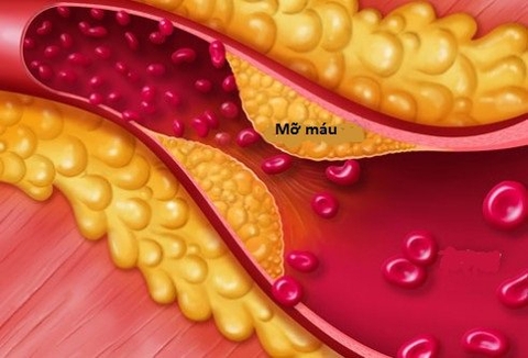 BỆNH MỠ MÁU LÀ GÌ, CÓ NGUY HIỂM KHÔNG?