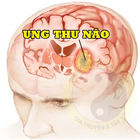 9 triệu chứng bệnh tâm thần nhẹ bạn nên lưu ý