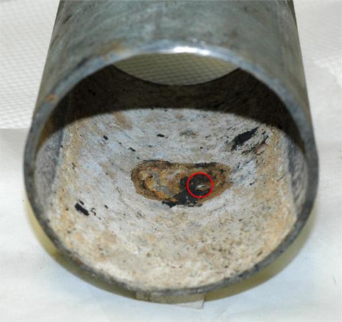 Hình (B) Rò rỉ xuyên thành bên dưới mụn (đã gỡ bỏ)