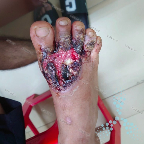 Cải thiện vết loét sau 1 tuần bổ sung dinh dưỡng chuyên biệt