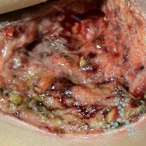 Nhanh lành vết thương áp xe hậu môn sau phẫu thuật trích rạch và dẫn lưu ổ áp xe