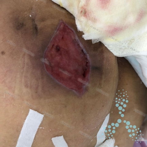 Áp xe mông ở người cao tuổi có bệnh nền đái tháo đường và suy thận