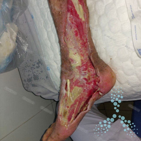 Đầy vết loét bàn chân đái tháo đường sau 5 tuần ở BN kèm biến chứng thần kinh và mạch máu