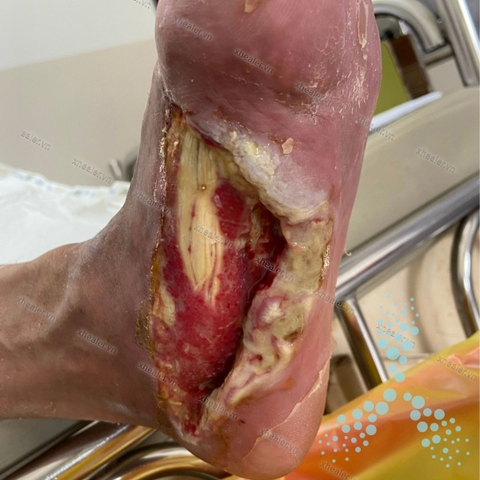 Bảo tồn được ngón chân và lành vết loét bàn chân đái tháo đường nhờ X-Healer