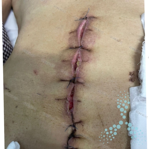 Nhiễm trùng vết mổ sau phẫu thuật cắt dạ dày