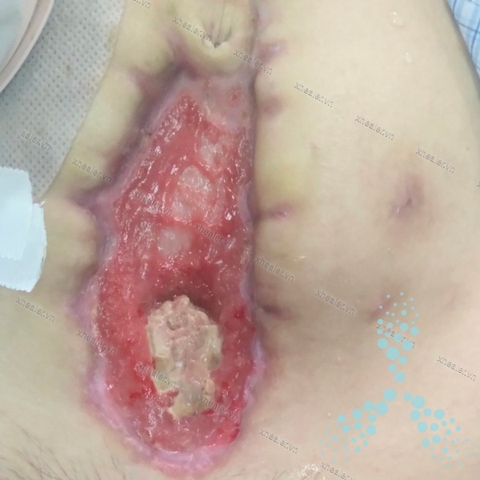 Hỗ trợ lành vết thương và tăng thể trạng ở bệnh nhân suy kiệt do biến chứng vết mổ