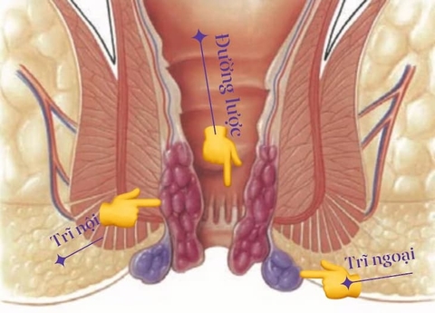 HIỂU VỀ BỆNH TRĨ ? CƠ CHẾ CHỮA BỆNH CỦA  AN TỌA VƯƠNG