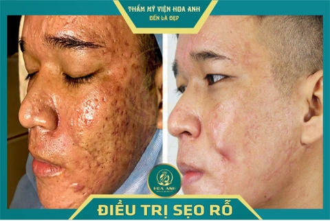TÁCH ĐÁY SẸO ĐIỀU TRỊ SẸO RỖ LÀ GÌ ? TÁCH ĐÁY SẸO CÓ TÁC DỤNG GÌ TRONG VIỆC TRỊ SẸO RỖ