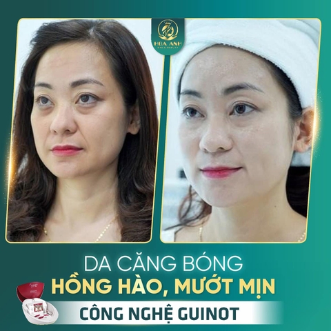 NÂNG CƠ XÓA NHĂN BẰNG CÔNG NGHỆ GUINOT LÀ GÌ ? NÂNG CÓ XÓA NHĂN CÓ TỐT KHÔNG