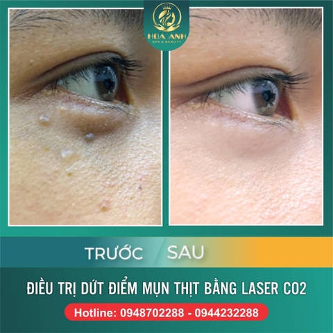 MỤN THỊT CÓ XÓA ĐƯỢC KHÔNG ? XÓA MỤN THỊT BẰNG LASER LÀ GÌ ?
