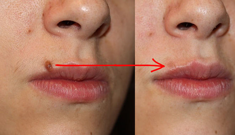 XÓA NỐT RUỒI KHÔNG ĐỂ LẠI SẸO - CÁCH CHĂM SÓC DA SAU KHI XÓA NỐT RUỒI BẰNG LASER
