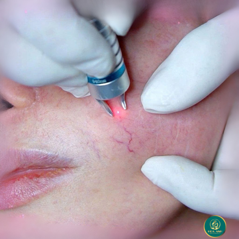 KHÓA HỌC ĐIỀU TRỊ MAO MẠCH ĐỎ DA CHUẨN Y KHOA