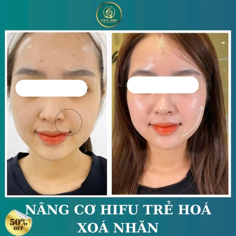 Khóa Học Trẻ Hóa Bằng Công Nghệ HIFU – Bí Quyết Làm Đẹp Thời Thượng