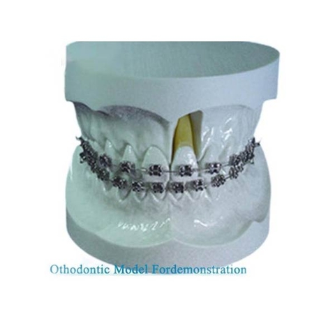 Mô hình chỉnh nha không khớp nối Mô hình chỉnh nha không khớp nối