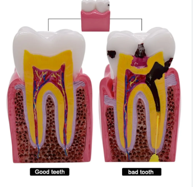 Mô hình răng sâu phóng đại 6 lần Mô hình răng sâu phóng đại 6 lần