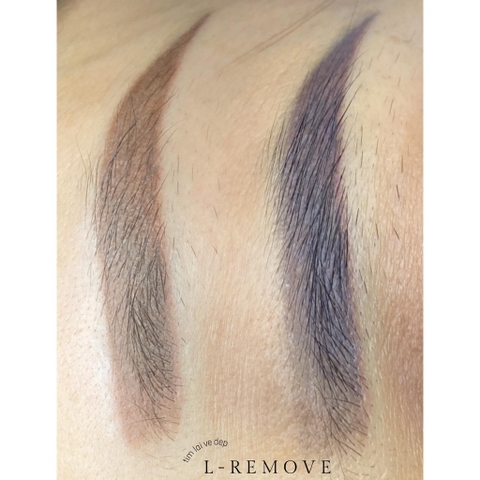 Dung Dịch Xóa Xăm L - Remove