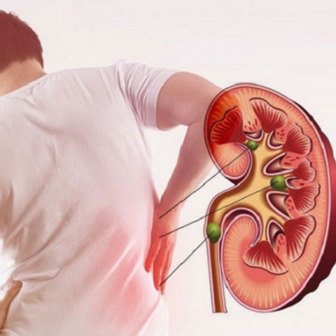 Suy Thận ở Người Trẻ: Vì đâu đến nổi và giải pháp phòng tránh hiệu quả