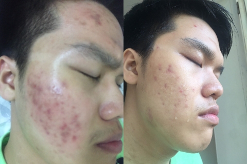 Phục hồi da thâm sau mụn thành công cho anh Nam tại GMS