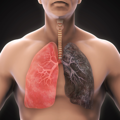 Gói tầm soát ung thư phổi - Vinmec / Lung cancer screening package