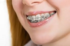 QUY TRÌNH NIỀNG RĂNG QUY TRÌNH NIỀNG RĂNG