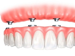 Nên sử dụng kỹ thuật cấy ghép Implant khi nào? Nên sử dụng kỹ thuật cấy ghép Implant khi nào?