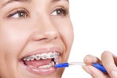 HÀM DUY TRÌ NIỀNG RĂNG HÀM DUY TRÌ NIỀNG RĂNG