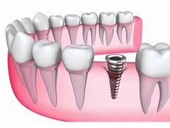 5 ưu điểm vượt trội của cấy ghép răng Implant 5 ưu điểm vượt trội của cấy ghép răng Implant