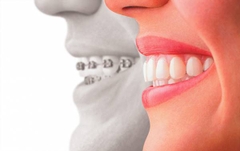 Niềng răng không mắc cài bằng công nghệ Invisalign hiện đại Niềng răng không mắc cài bằng công nghệ Invisalign hiện đại
