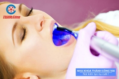 Tẩy trắng răng Laser Whitening