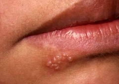 Gel trị tróc mép Herpes và zona thần kinh SOS Lippenherpes