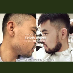 minoxidil moc rau