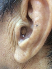 people-use-cic-hearing-aid