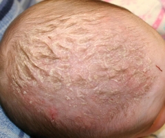 Tìm hiểu nguyên nhân và cách chữa cứt trâu ở trẻ sơ sinh 
