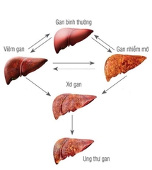 CÁC BỆNH THƯỜNG GẶP Ở GAN