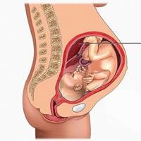 Ác lộ bất tuyệt - Sót rau thai khi sinh