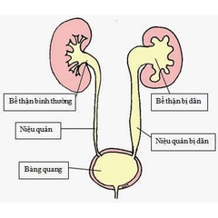 Giãn thận, căn bệnh không thể chủ quan